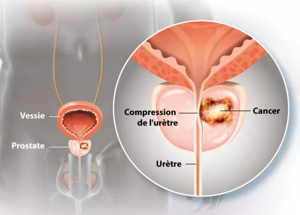 Le sexe après le cancer de la prostate