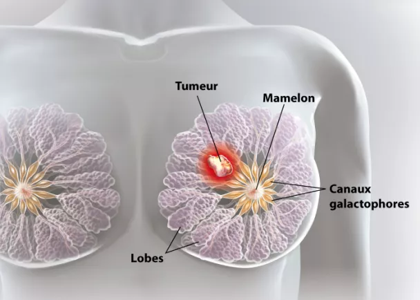 Cancer du sein : facteurs, symptômes et thérapies