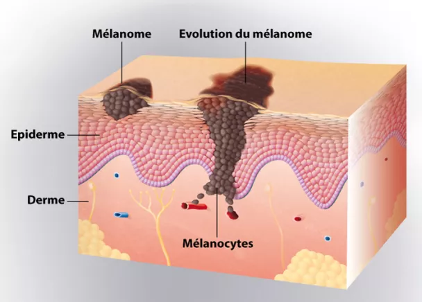 cancer de la peau mélanome