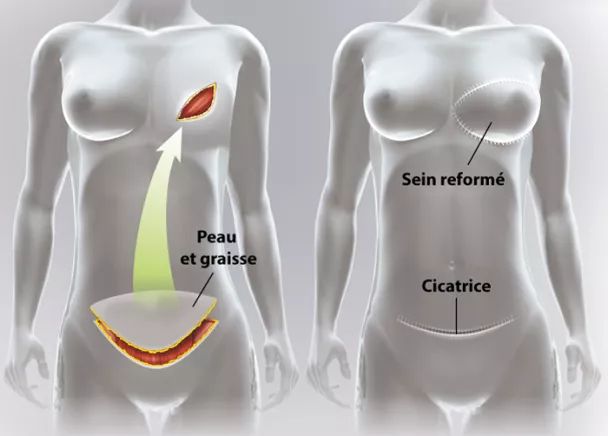 J'ai les seins tombants, quelles solutions de chirurgie esthétique ?, Institut du Sein