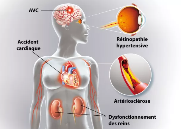 L'hypertension artérielle : symptômes et traitements