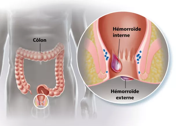 Hémorroïdes internes ou externes: reconnaître les symptômes - Le conseil  santé