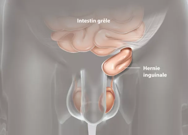 Douleur au testicule : reconnaître une hernie inguinale