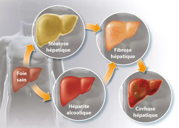 Toxicité de l'alcool sur le foie