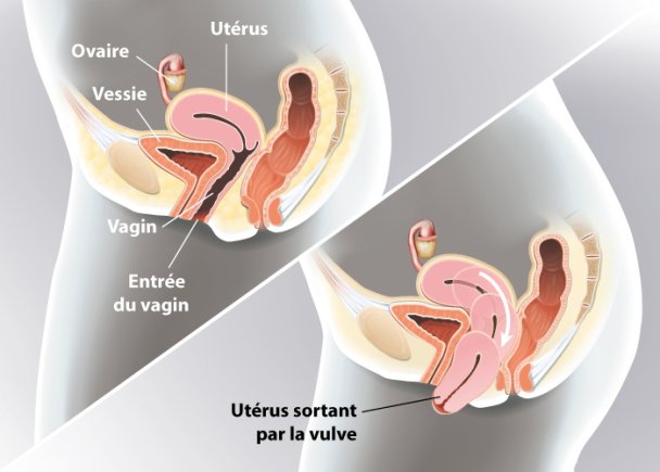 Prolapsus | Ramsay Santé