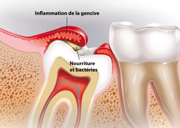 Déroulé de l'extraction des dents de sagesse