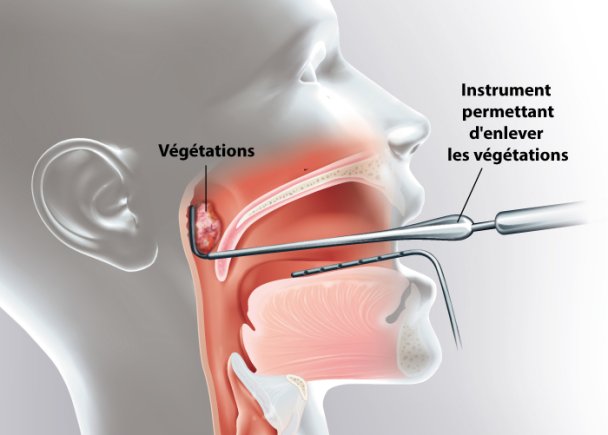 Ablation Des Vegetations Ramsay Sante