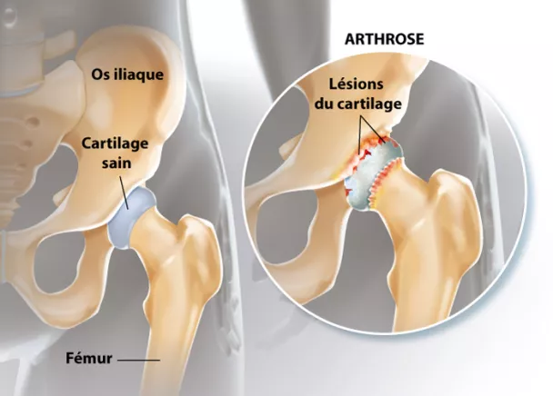 Traitement de l'arthrose