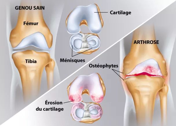 Arthrose du genou - Douleur d'arthrose au genou