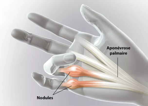 Début d'un Dupuytren à la main - Les premiers symptômes de la