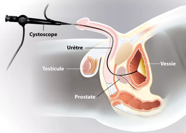 Cystoscopie  Ramsay Santé