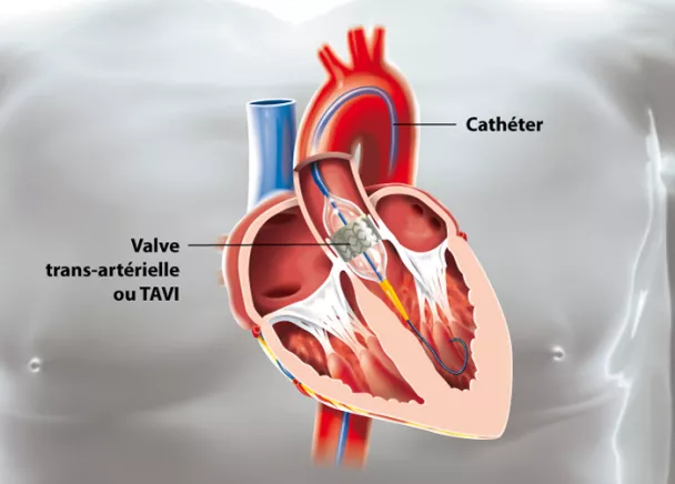Sténose de la valve aortique (rétrécissement de la valve cardiaque)