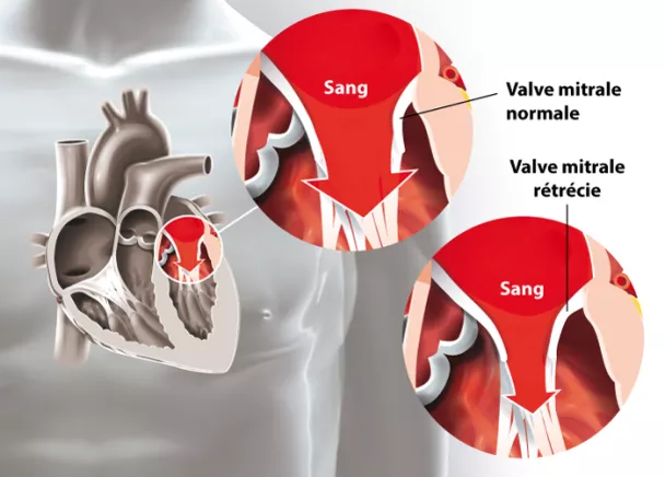 Les maladies des valves cardiaques