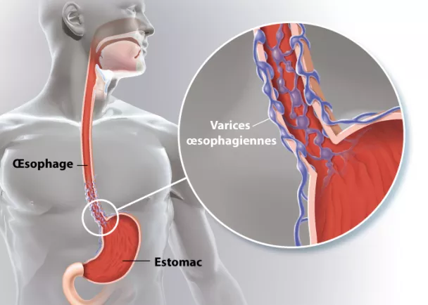 Hémorroïdes à Pau - Centre de Chirurgie digestive et de l'Obésité