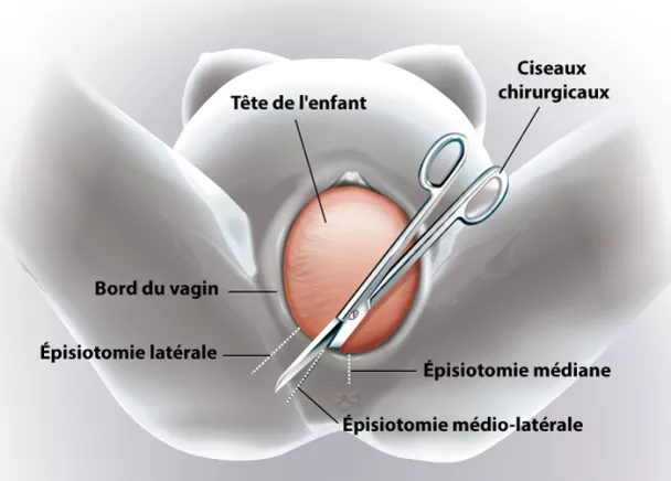 Lochies, tranchées, épisiotomie, déchirure : le langage à connaître