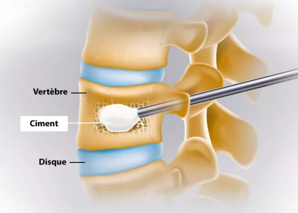 Arthrodèse vertébrale