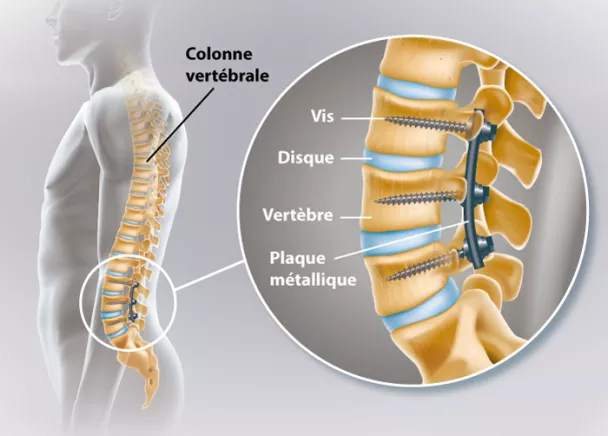 Arthrodèse vertébrale