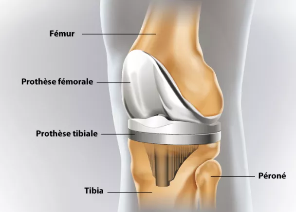 L'opération de prothèse du genou a cause de l'arthrose 😱 #urgence #re