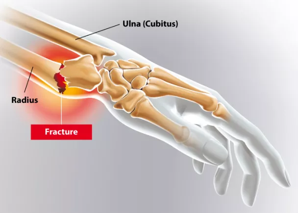 Fracture de l'avant-bras : symptômes, traitement, définition