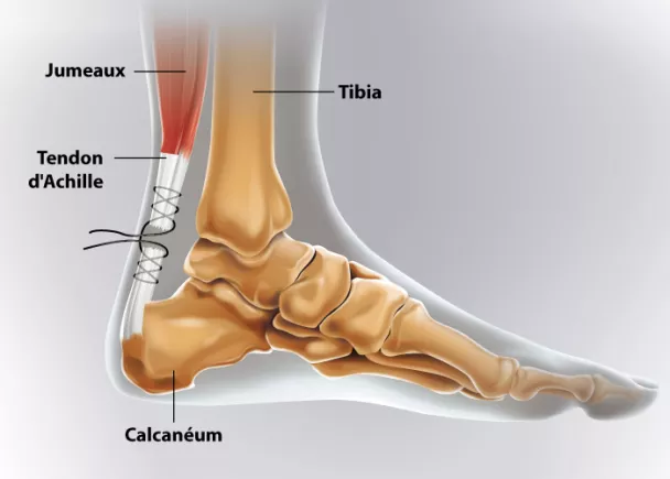 Rupture du tendon d Achille Ramsay Sant