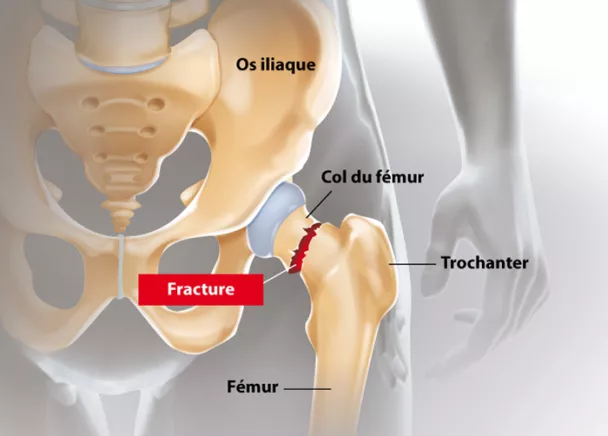 Fracture du col du fémur - Col du fémur cassé
