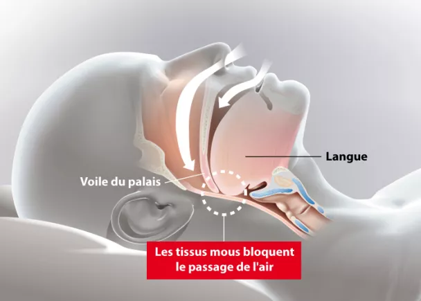 J'évalue mon risque d'avoir des apnées du sommeil