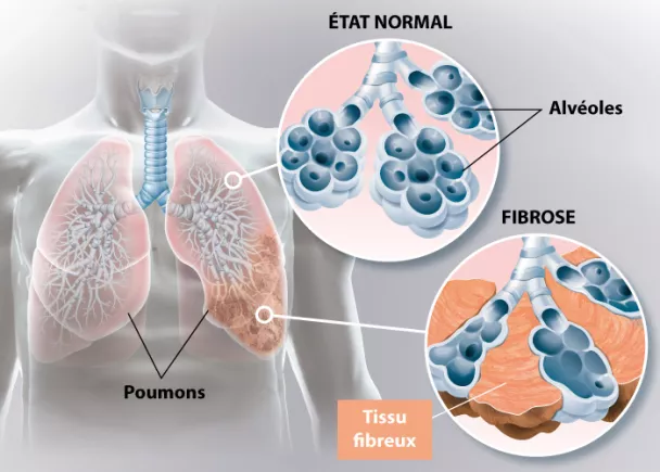 Appareil d'Exercice Pulmonaire – FibroAir