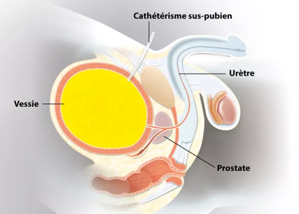 Comment introduire une sonde urinaire pour homme