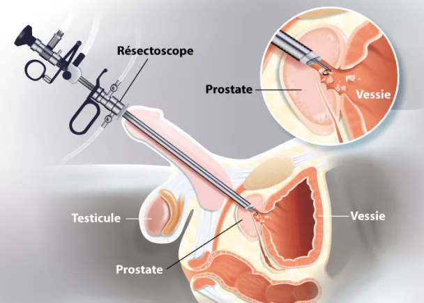 Le sexe après le cancer de la prostate