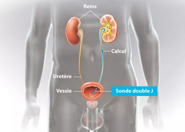 Sonde urinaire en « double J »